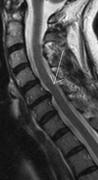 MRI showing bone spur pressing on spinal cord. | Does this p… | Flickr