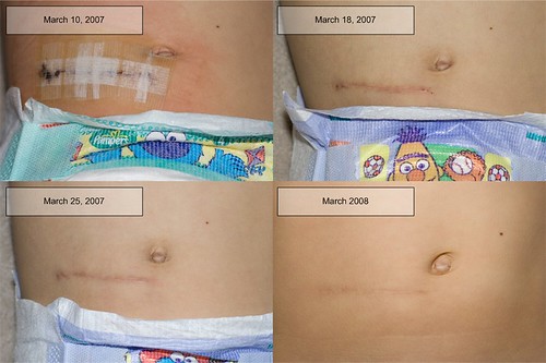 surgery-scar-healing-stages-treat-your-scars