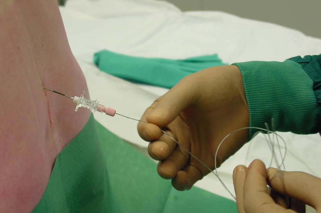 Catheter insertion | Insertion of the epidural catheter ...