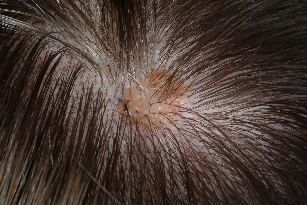 scalp conditions pictures