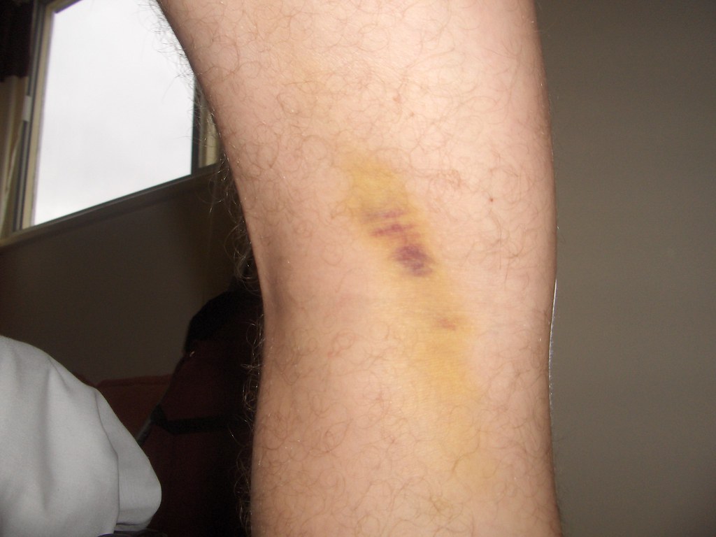 Bruising behind left knee 4 days after ACL surgery | Flickr