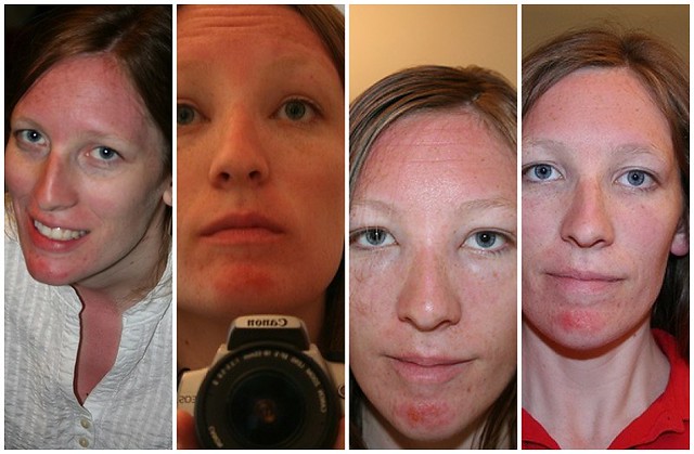 progression-of-a-sunburn-i-had-what-i-am-guessing-is-an-al-flickr