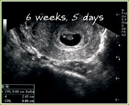 heartbeat at 6 weeks