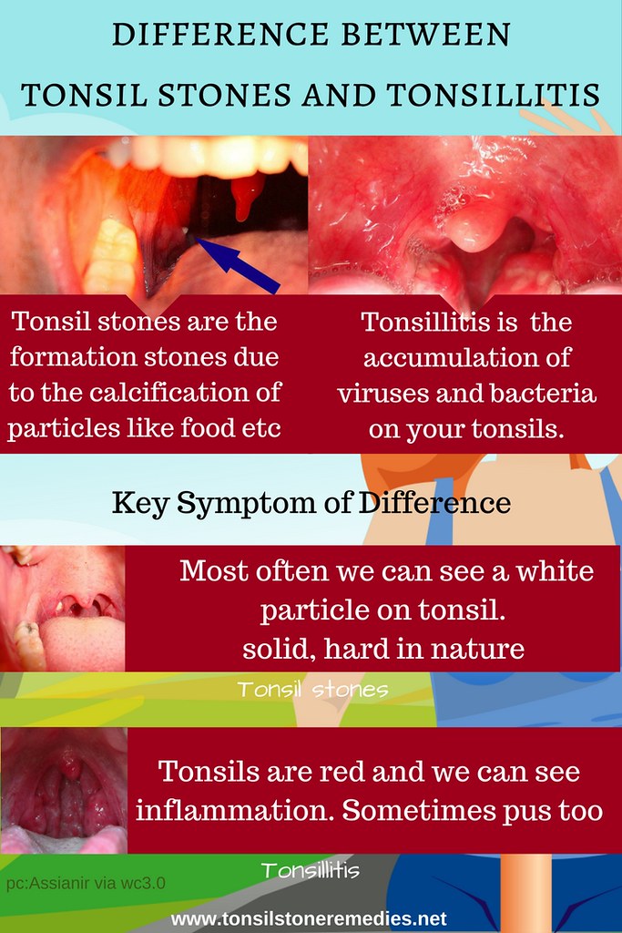 Differences Between Tonsil Stones And Tonsillitis | The Diff… | Flickr