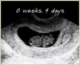 Ultrasound at 8 weeks, 4 days | Ever growing, we were able ...