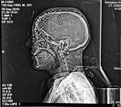 X-ray image of a pellet gun victim