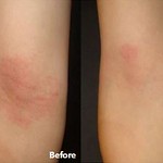 Dr. Joel Schlessinger explains the difference between eczema and psoriasis