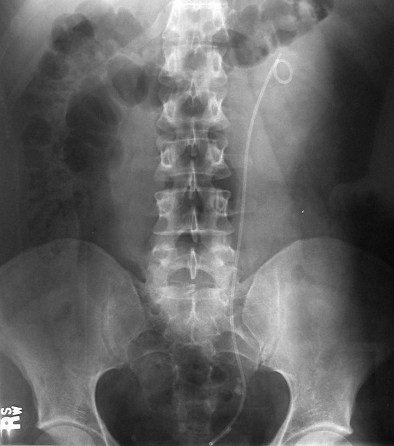Kidney Stone X-Rays