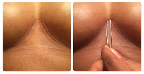 The tweezers are used to show where my breast tissue is. The outer portion of the wire is sitting on breast tissue