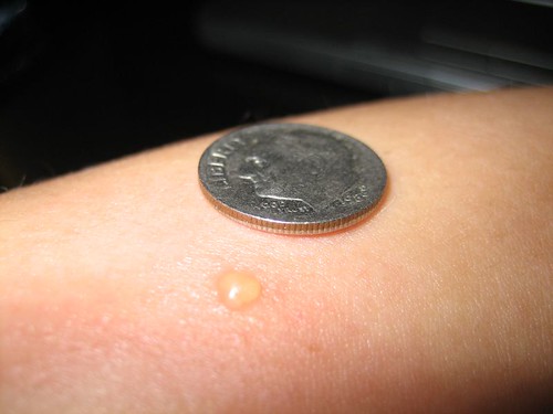 strange blister bug bite | Flickr - Photo Sharing!