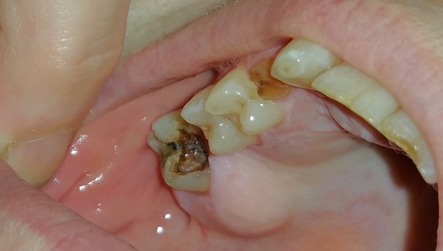 Tooth infection