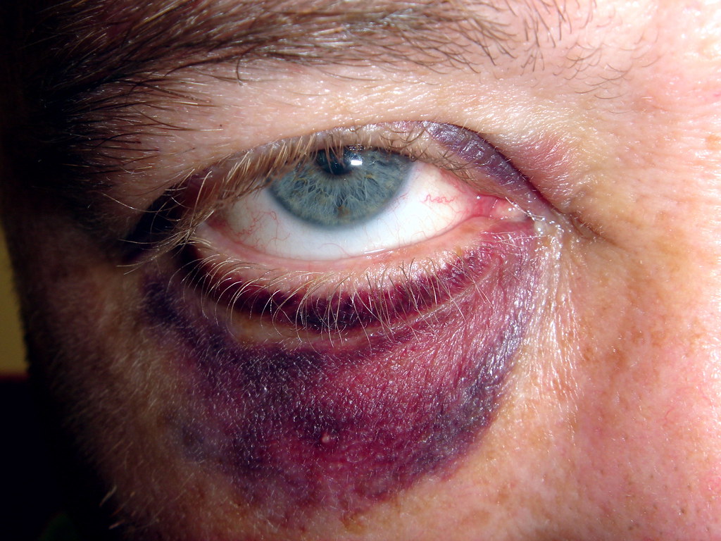 Image result for black eye