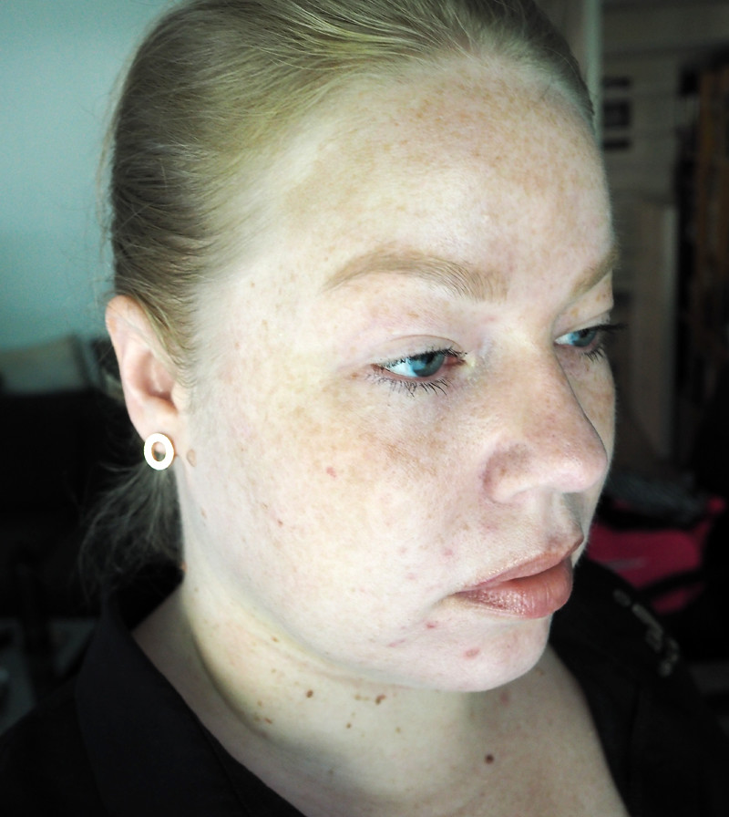 vitiligo pale freckled skin