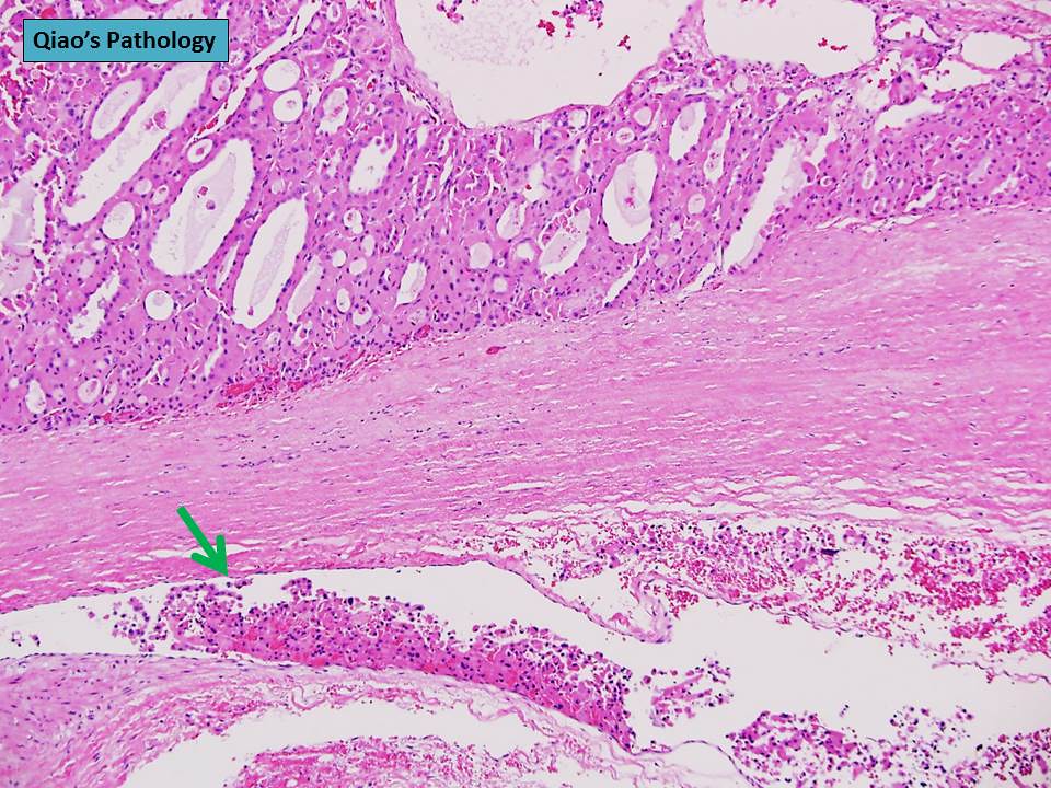 Hürthle cell carcinoma of the thyroid gland | Flickr