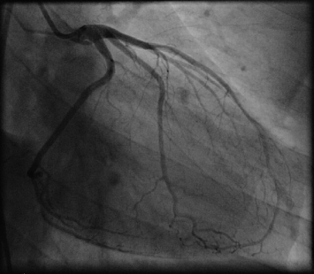 Angiogram | My coronary arteries perfused with radiopaque dy… | Flickr