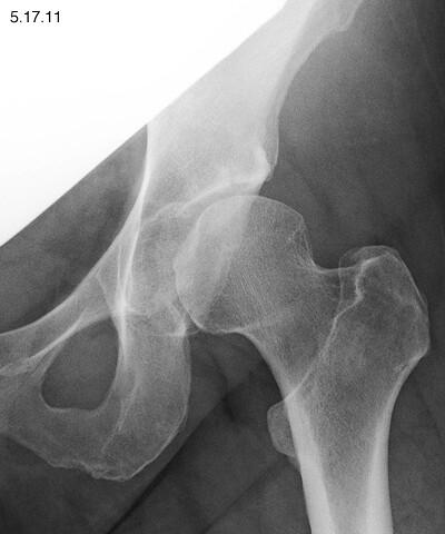 left hip x-ray, pre-surgery | Uncorrected acetabular dysplas… | Flickr