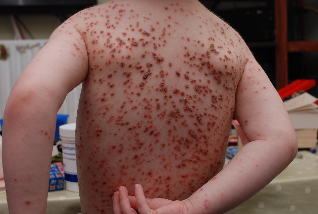 Chickenpox Pictures During All Stages - Verywell