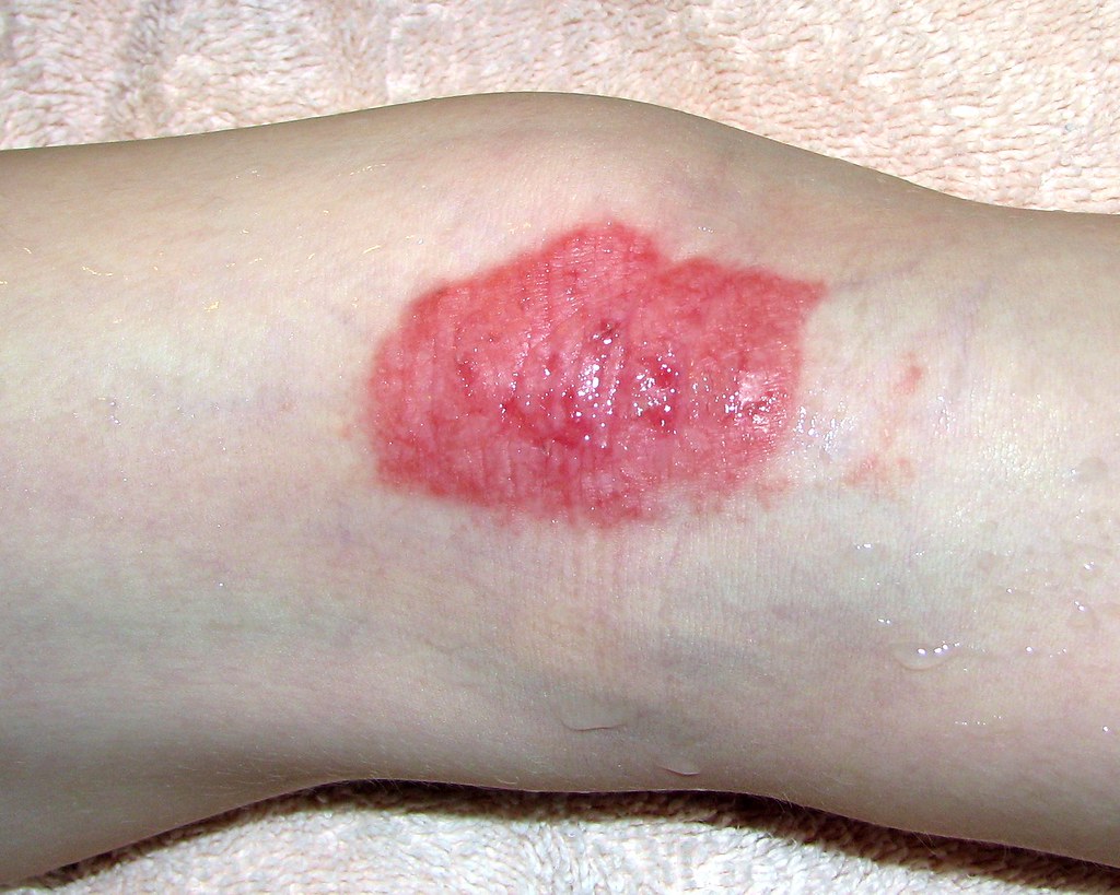 eczema-behind-knee-7-yrs-old-note-the-dark-red-color-sk-flickr