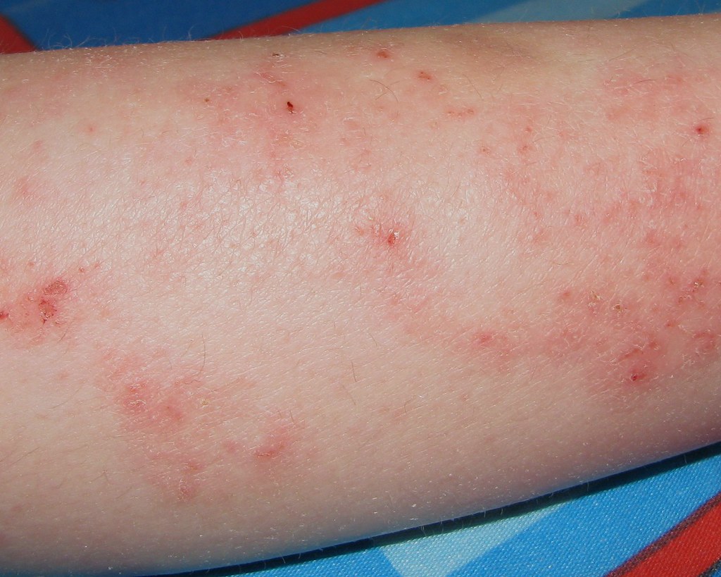 Eczema on a 6yr old - shins | for medical files | Care_SMC | Flickr