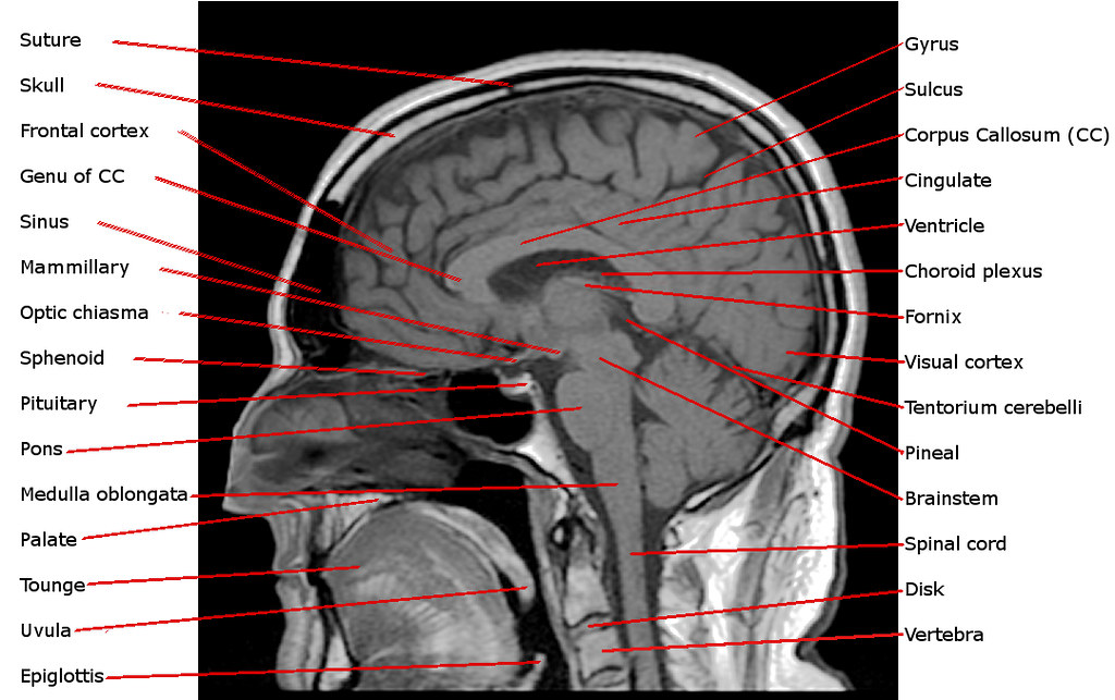 Annotated Sagittal T1 Midline MRI Scan of Reigh's Brain | Flickr