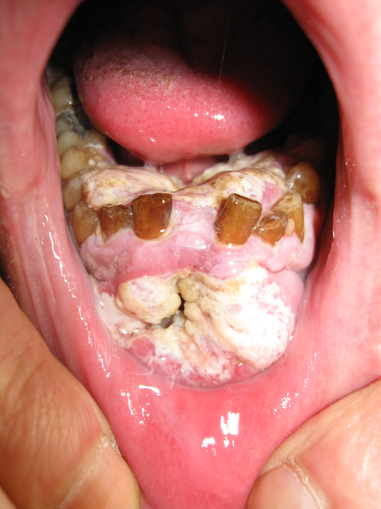 mouth cancer 