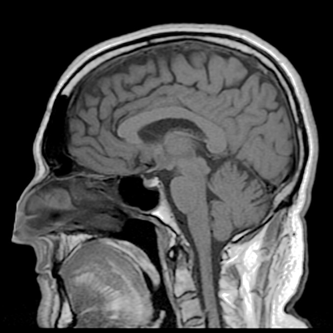 Sagittal T1 Midline Mri Scan Of Reighs Brain This Is One Flickr