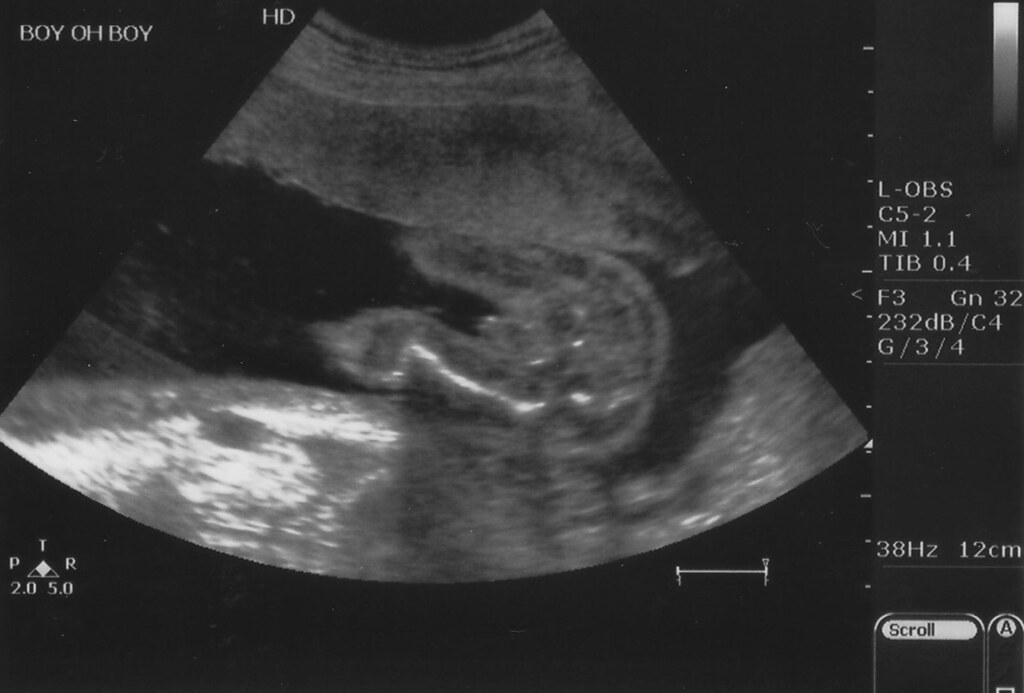 Беременность 19 20 недель фото узи