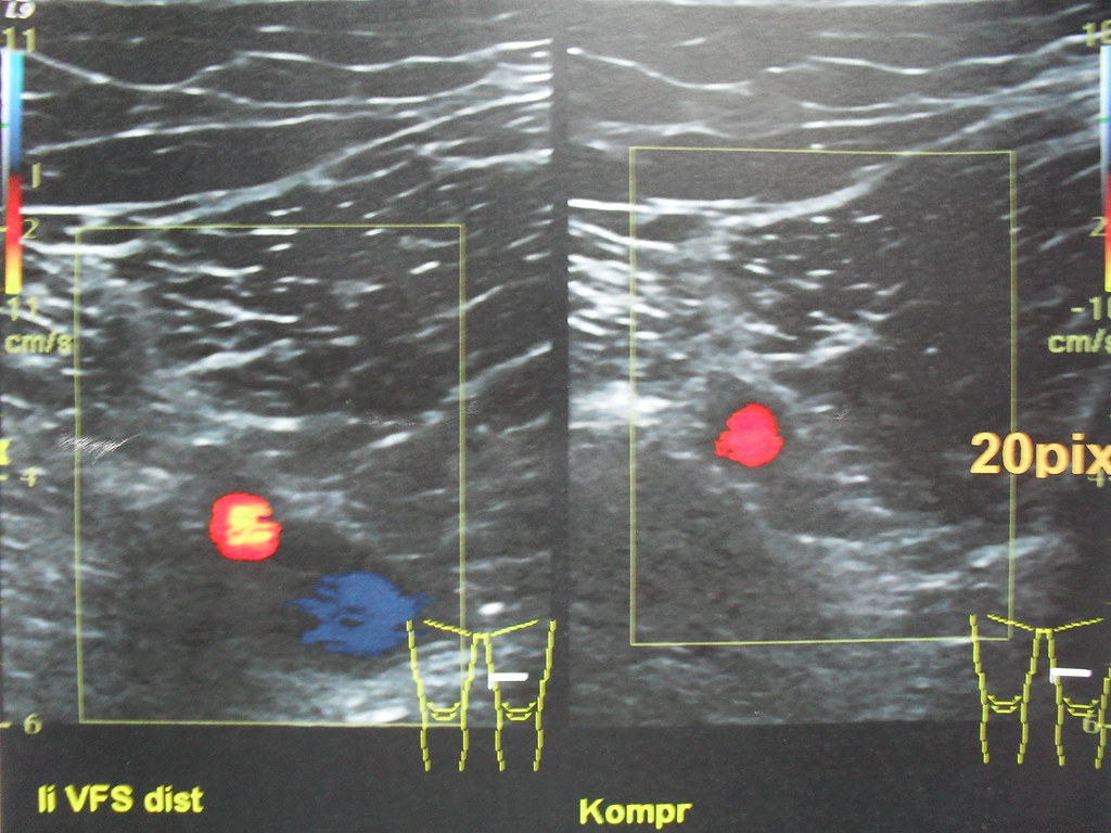 leg ultrasound for dvt