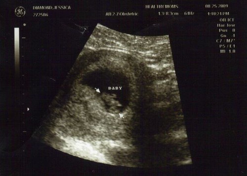 photo of 7 week fetus