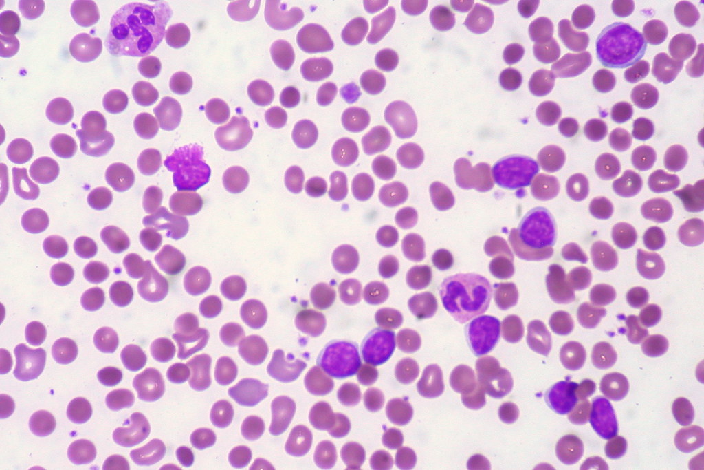 Resultado de imagen de anemia