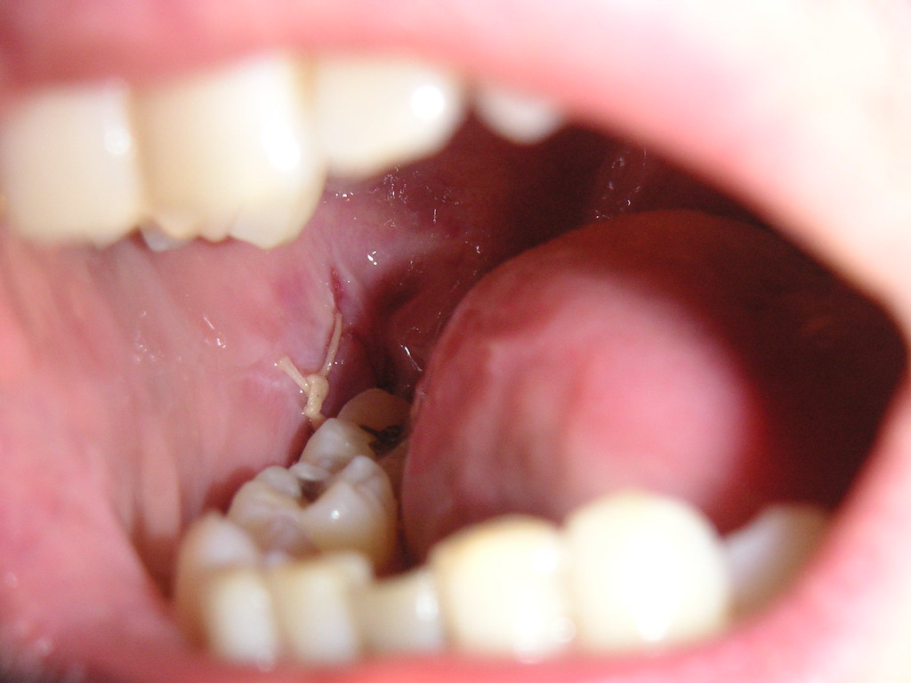 Stitches | A close-up of stitches in my mouth following a wi… | Flickr