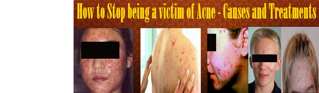 How to Stop being a victim of Acne - Causes and Treatments… | Flickr