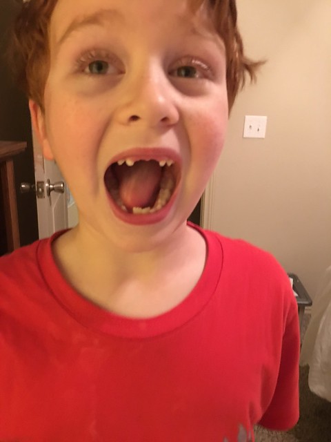 3rd tooth in a week!