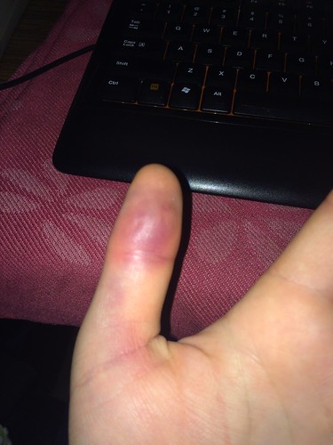 Left Thumb Injury (Feb 26 2016) (2)