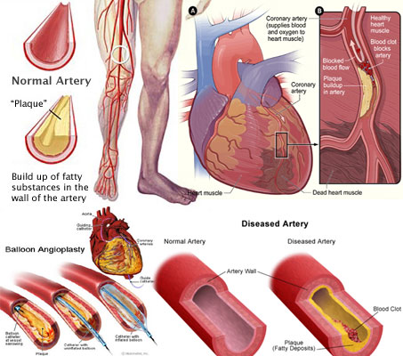 Peripheral-Artery-Disease