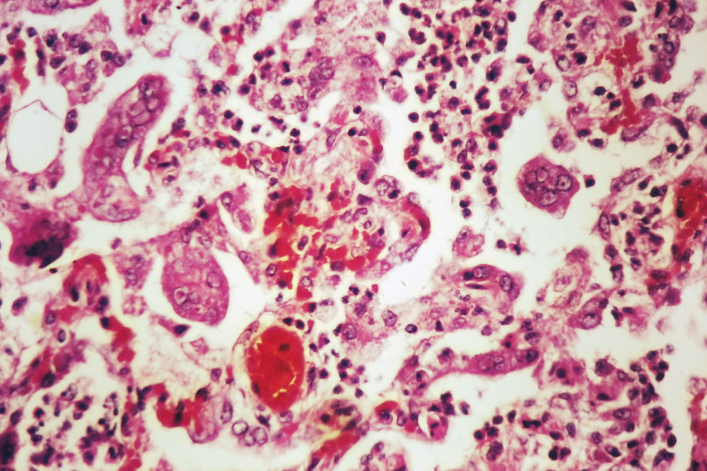 Image result for measles