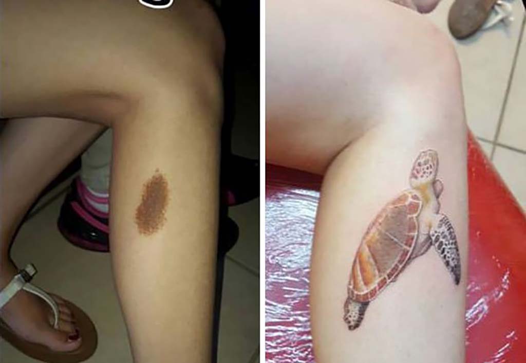 Tattoos covering up birthmarks: The most creative scar & birthmark tattoos & tattoo ideas – Sea Turtle