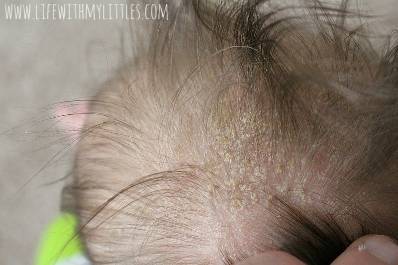 Not sure how to get rid of cradle cap? Here's an easy and inexpensive treatment that works in less than a week! 