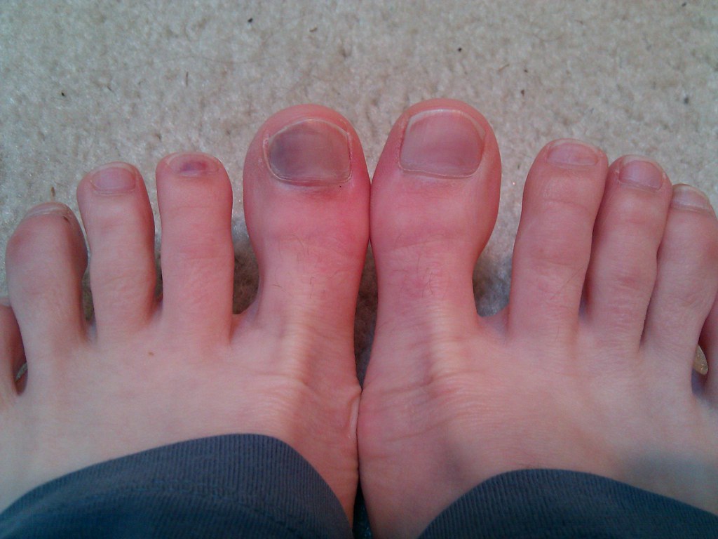 some-bruised-toenails-morgan-ames-flickr