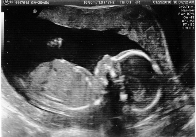 20 Week Ultrasound! (cropped) We had our 20week anatomy