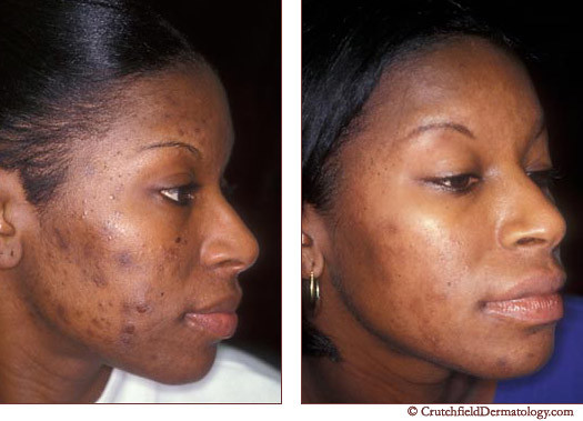 Acne laser treatment on African American woman :before & a… | Flickr
