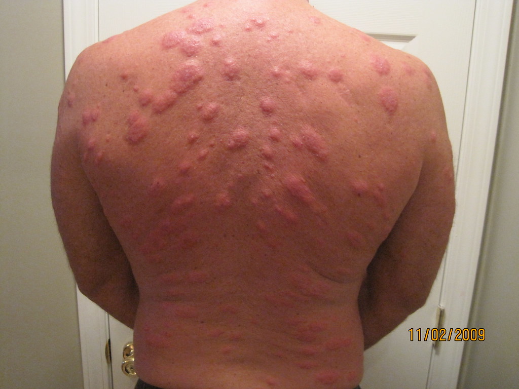 images of scabies rash #11