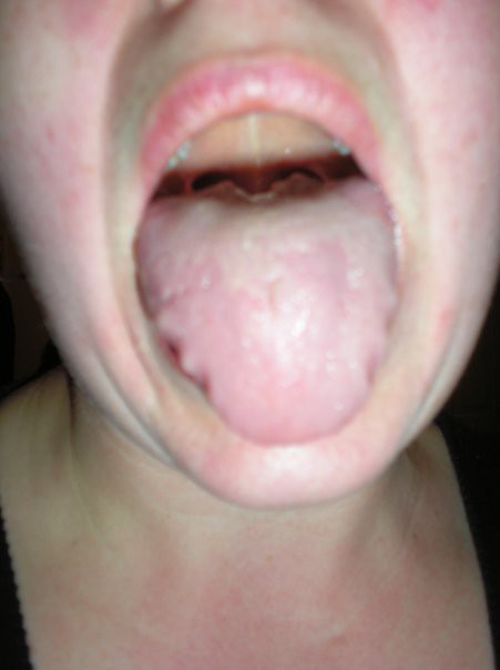 Swollen Tongue Mouth 101