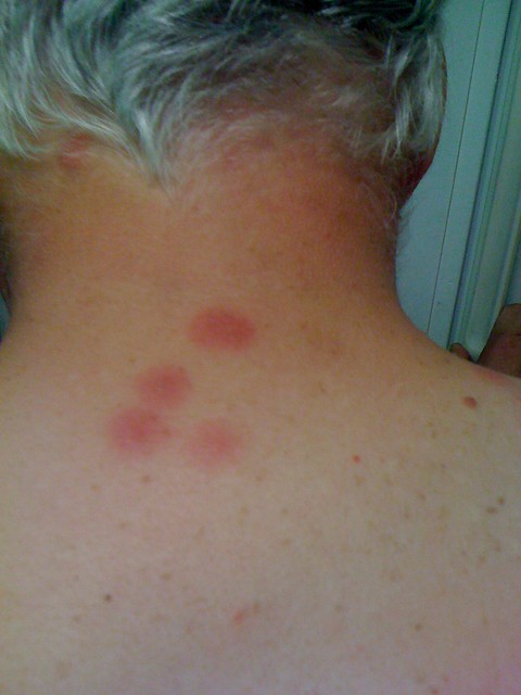 Bed Bug Blisters Images Bangdodo