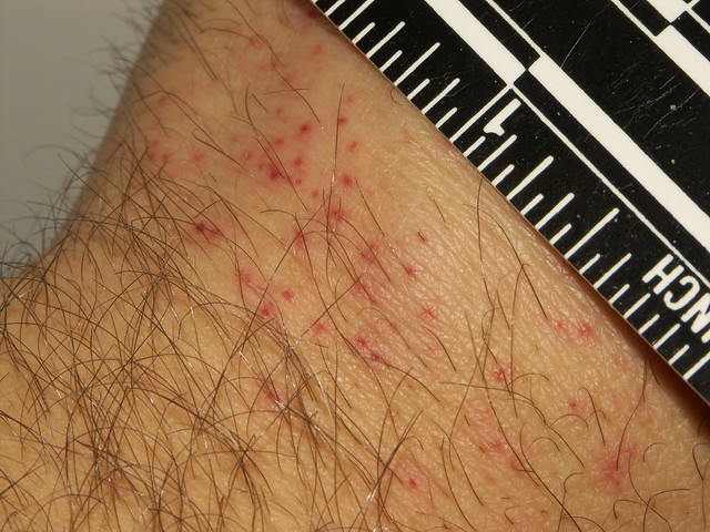 Bed bug bites visible hours after feeding | Flickr - Photo Sharing!