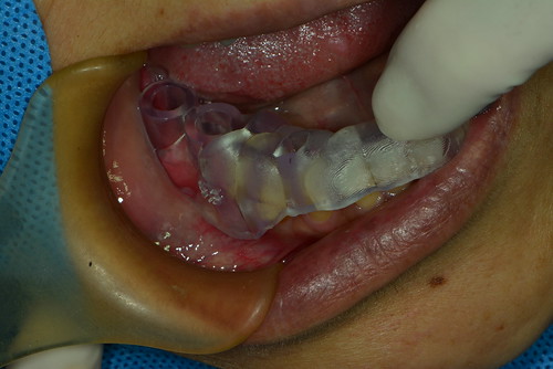 擔心植牙失敗風險？黃泓傑醫師分享植牙手術導板案例讓植牙定位精又準(12)