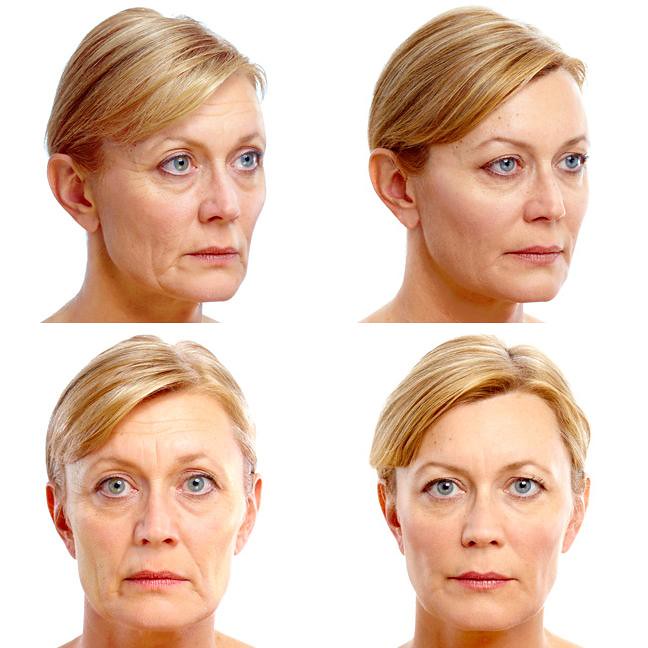 臉部下垂如何改善？皮膚下垂如何改善？療程該如何選擇？美上美皮膚科的電波拉皮、音波拉皮改善下垂困擾！醫師提醒低頭族長時間往下看，也是造成臉部下垂的原因。