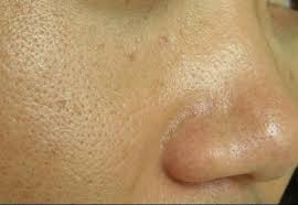 毛孔粗大是肌膚常見的一種問題，臉上毛孔粗大怎麼辦？皮秒雷射跟淨膚雷射專治毛孔粗大，讓您皮膚更緊緻！基因跟老化是造成毛孔粗大的元兇，用皮秒雷射治療很有效