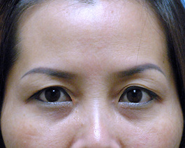 淚溝的填補是玻尿酸裡需要高技術的技巧，玻尿酸如果打不好，會造成難看的不平整。如果淚溝很明顯，眼袋會看起來很大，代表臉部開始老化！玻尿酸解決您淚溝問題。