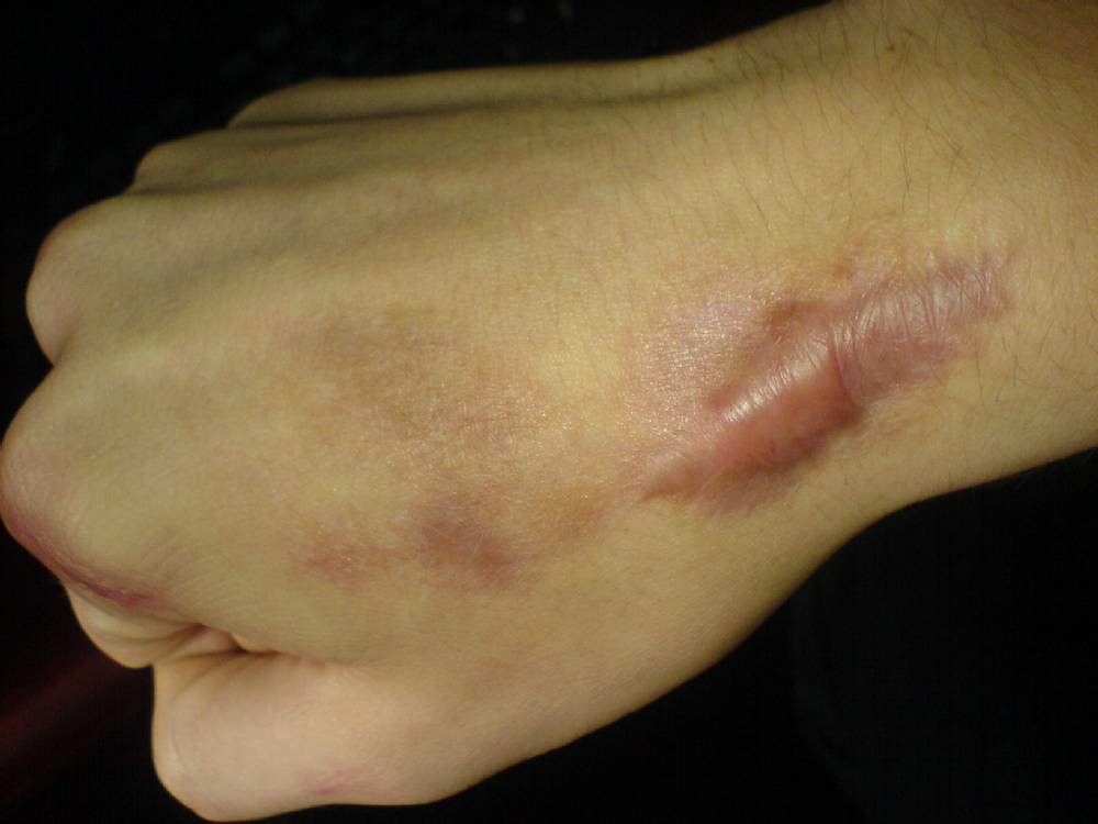不論是什麼疤痕都可以透過很多種疤痕治療的方式來做淡化消除！想治療疤痕、淡化疤痕交給莊盈彥醫師就對了！